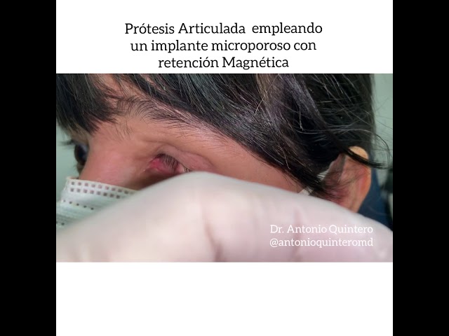 las protesis oculares las cubre la seguridad social