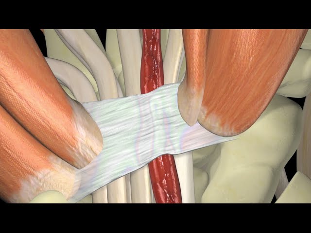 sindrome del tunel que afecta a la muñeca